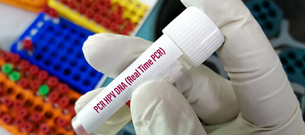 Novo exame de PCR permite detecção do HPV alto risco em amostras de colo uterino