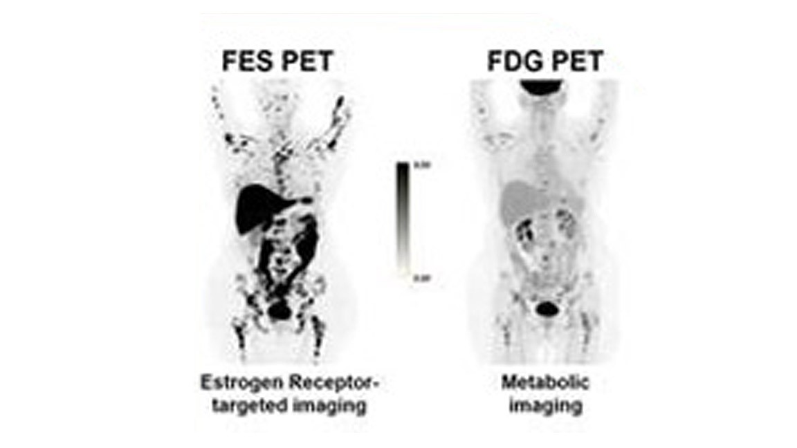 Eficiência no diagnóstico de tumores de mama - PET com Fluorestradiol F18
