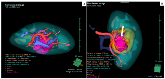 Angiotomografia Computadorizada do Abdome com Reconstrução Tridimensional Morfofuncional para Planejamento de Nefrectomia Parcial