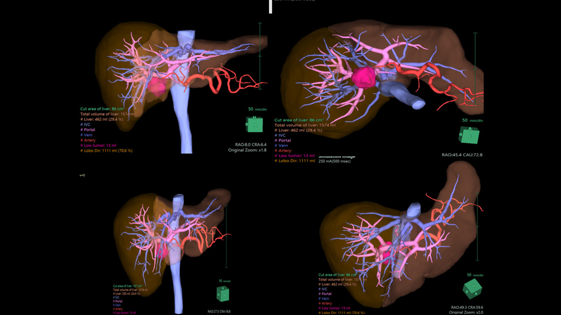 Angiotomografia computadorizada do abdome com reconstruções 3D e volumetrias para planejamento terapêutico