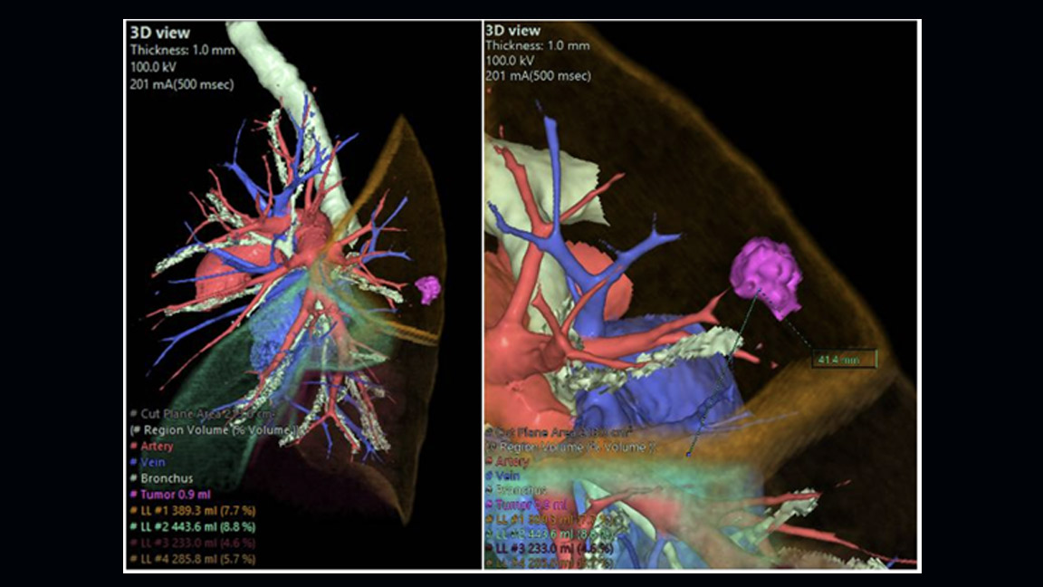 Angiotomografia Computadorizada de Tórax com Reconstruções 3D para Planejamento Cirúrgico