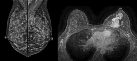 A evolução da Ressonância Magnética de Mamas no Screening do Câncer de Mamas