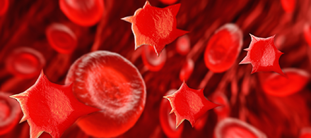 Pesquisa de Acantócitos no Sangue Periférico